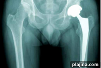 Over 1 Million U.S. Citizens Travel Abroad Each Year for Joint Replacement